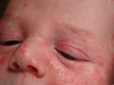 heat rash on babies pictures. heat rash on abies. heat