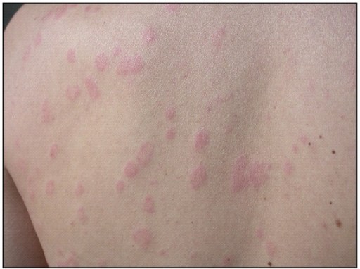 urticaria