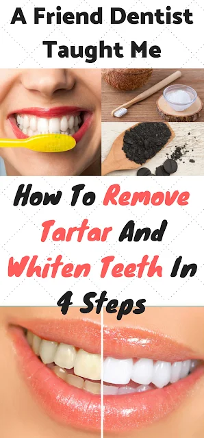 A medical officer Tells Maine how to Get Rid of Tartar, Periodontitis, and Whiten My Teeth in Four Steps with Do-it-yourself Directions