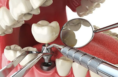 Trồng răng giả bằng implant có đau không?