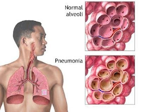 Apa itu penyakit radang paru-paru atau lebih di kenali sebagai paru-paru berair?