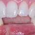 Nhổ răng bao lâu thì trồng lại được bằng răng sứ?