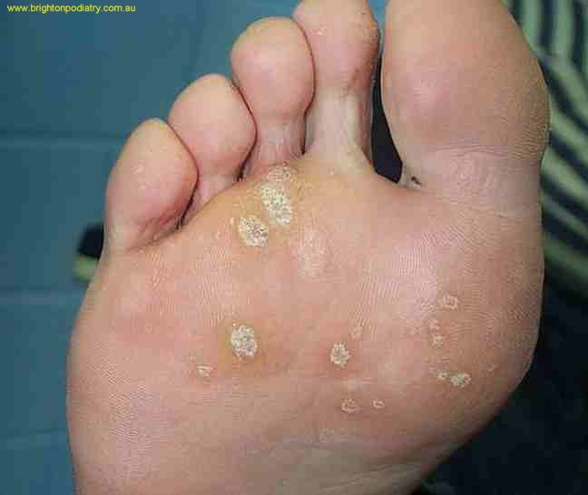 common warts on legs. dresses images common wart