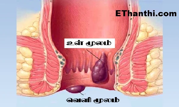 மூல நோய் என்றால் என்ன? அதற்கான காரணம் என்ன?