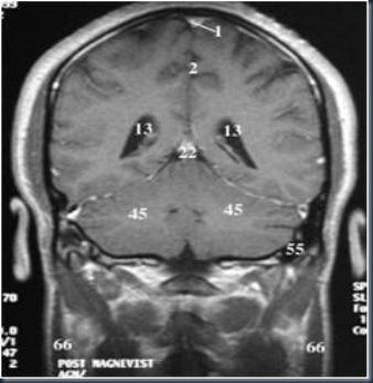 Anotak coronal2