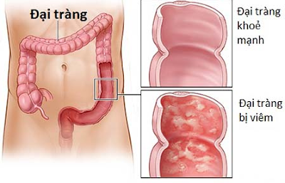 Bệnh viêm kết tràng