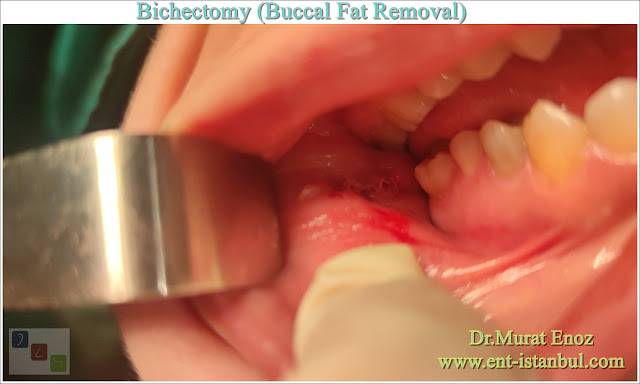 Bichectomy, Buccal Fat Removal, Buccal fat extraction, Hollywood cheek, Cheek Thinning Surgery, Cheek Fat Removal, Extended buccal lipectomy