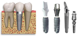 Cấy ghép Implant tồn tại bao lâu ?