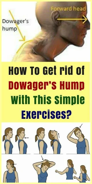 How To Get rid of Dowager's Hump with This Simple Exercises?
