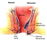 external hemmroid pic
