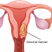 Cervical cancer may get eliminated in this century: Study