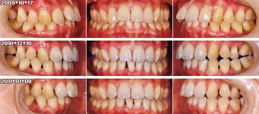 歯列矯正：定期検診その5
