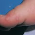 வேகமாகப் பரவும் Hand-Foot-Mouth Disease எனும் ஒரு வைரஸ் நோய்