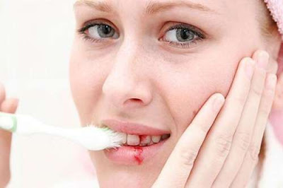 4 nguyên nhân khiến nướu chảy máu khi đánh răng-1