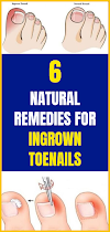 6 Natural Remedies For Ingrown Toenails