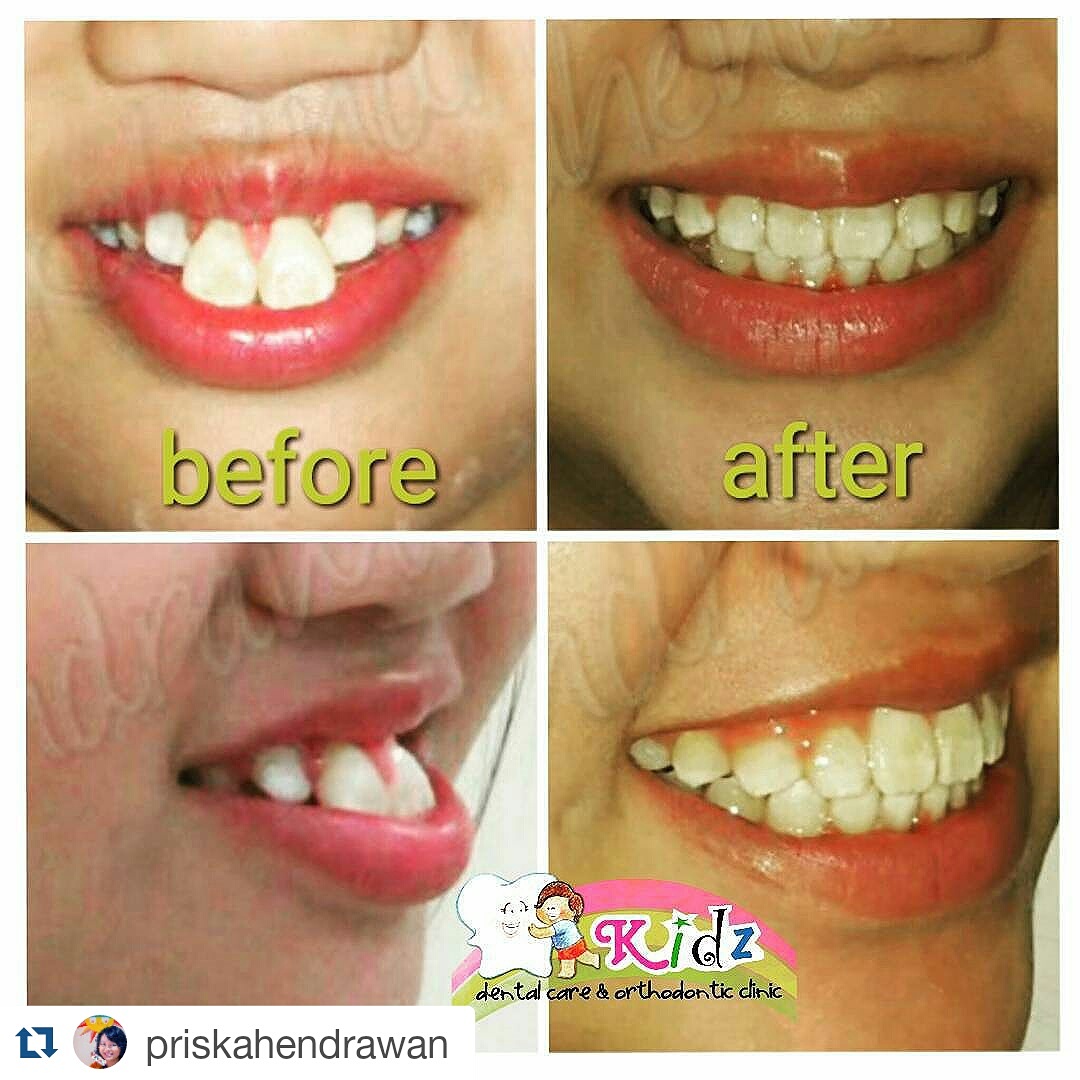 Bahaya Behel Gigi Online Shop Kidz Dental Care