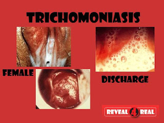 BAHAYA DAN CARA MENGOBATI TRIKOMONIASIS SECARA ALAMI