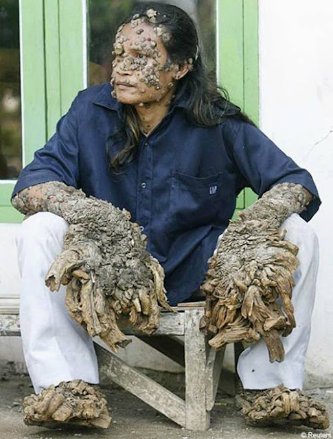 tree man after. Dede Koswara the tree man