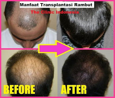 Manfaat Transplantasi Rambut