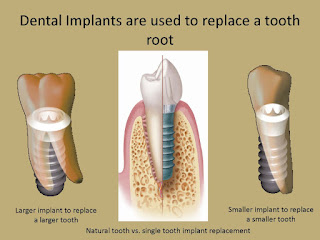 Dental Implants