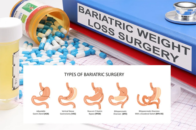 Bariatric Surgery