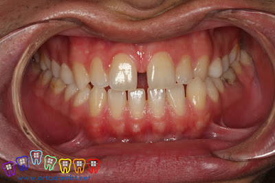 diastema tedavisi - ortodontist - dişler arası boşluk tedavisi