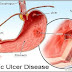 Peptic ulcer