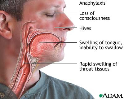 reaksi dari sistem kekebalan  yang terjadi ketika jaringan badan yang normal mengalami ced Reaksi Alergi