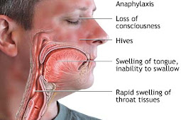 Anafilaksis (Reaksi Alergi Akut)