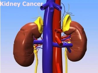 Kidney Cancer