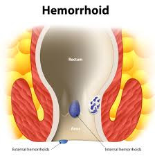 Hemorrhoids (piles) and the relationship between cancer,hemorrhoids surgery,hemorrhoids symptoms