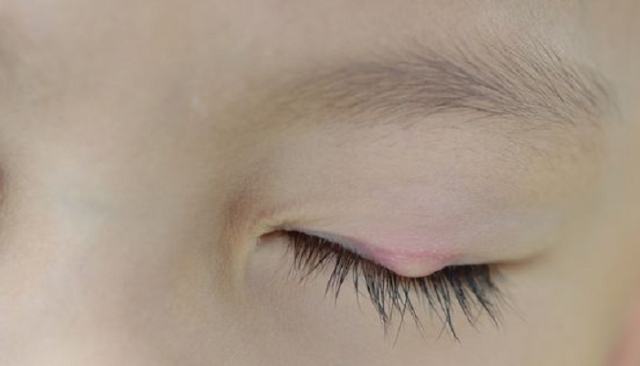 Meaning of pimple location appears on the eye