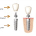 Cấy ghép implant