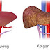 Chế độ ăn uống lành mạnh cho người bị xơ gan