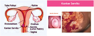 obat kanker serviks alami paling manjur di apotik umum