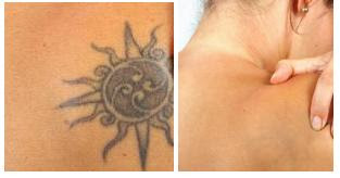 Natural Tattoo Removal: Why Choose Natural Tattoo Removal Instead of ...