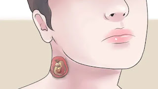Nódulo no Pescoço: Afinal, o que Pode Ser?