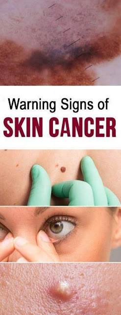 Skin Cancer Warning Signs