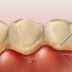 Cạo vôi răng có gây đau đớn gì không?