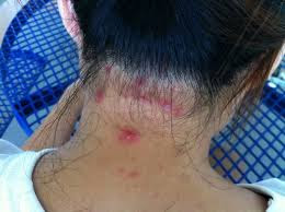 Folliculitis