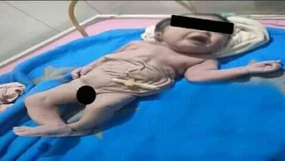 ولادة طفل بدون بطن في محافظة الأقصر.. والطبيب: زواج الأقارب السبب