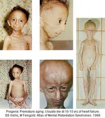 Progeria ( Proses penuaan yang sangat cepat )