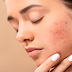 Scars On Face : 10 Home Remedies to Reduce Scars on the Face