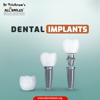 dental-implants