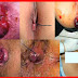Obat Benjolan Ambeyen di Sekitar Anus/Dubur thumbnail