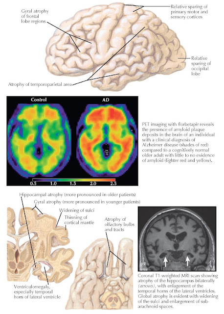 ALZHEIMER DISEASE: PATHOLOGY