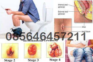 BAB Keluar Benjolan Daging Lunak Apakah Wasir