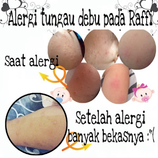 alergi tungau debu pada anak