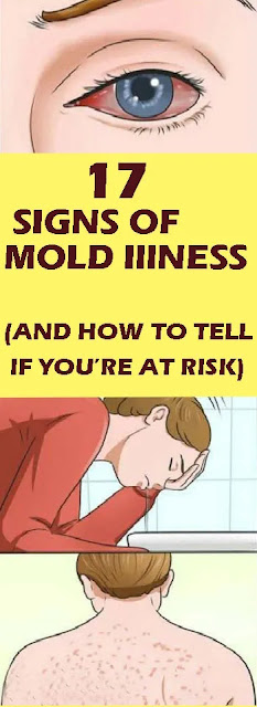 17 Signs Of Mold Illness (And How To Tell If You’re At Risk) – Ultimate guide to health care