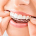 Niềng răng bằng nhựa dẻo có ưu điểm gì?